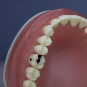 dente-diferenciado-16.2-CLASSE-II