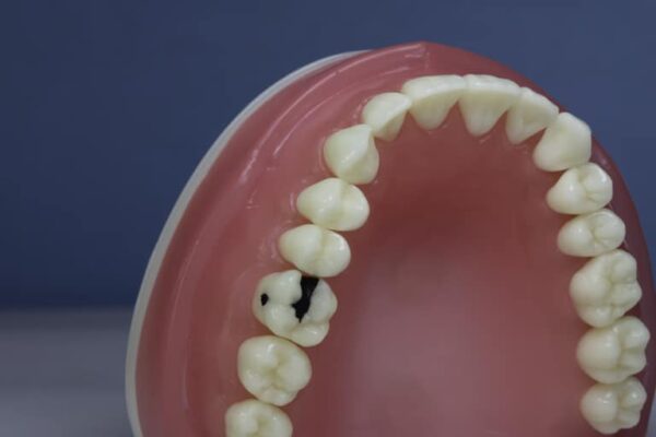 dente-diferenciado-16.2-CLASSE-II
