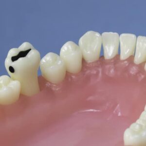 Dente Diferenciado 36.2 Classe I na Face Oclusal Cariado